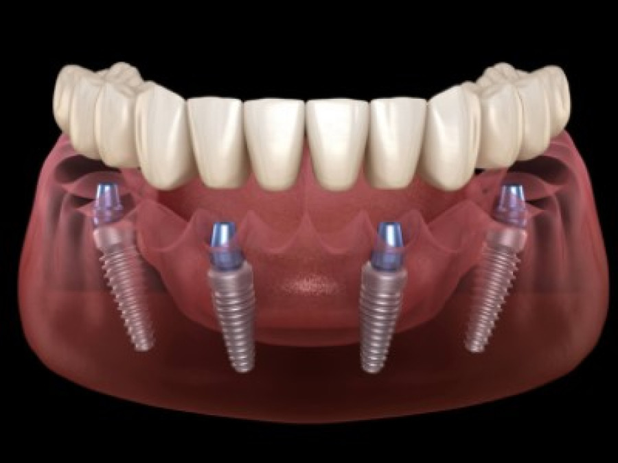 Bursa İmplant Tedavisi