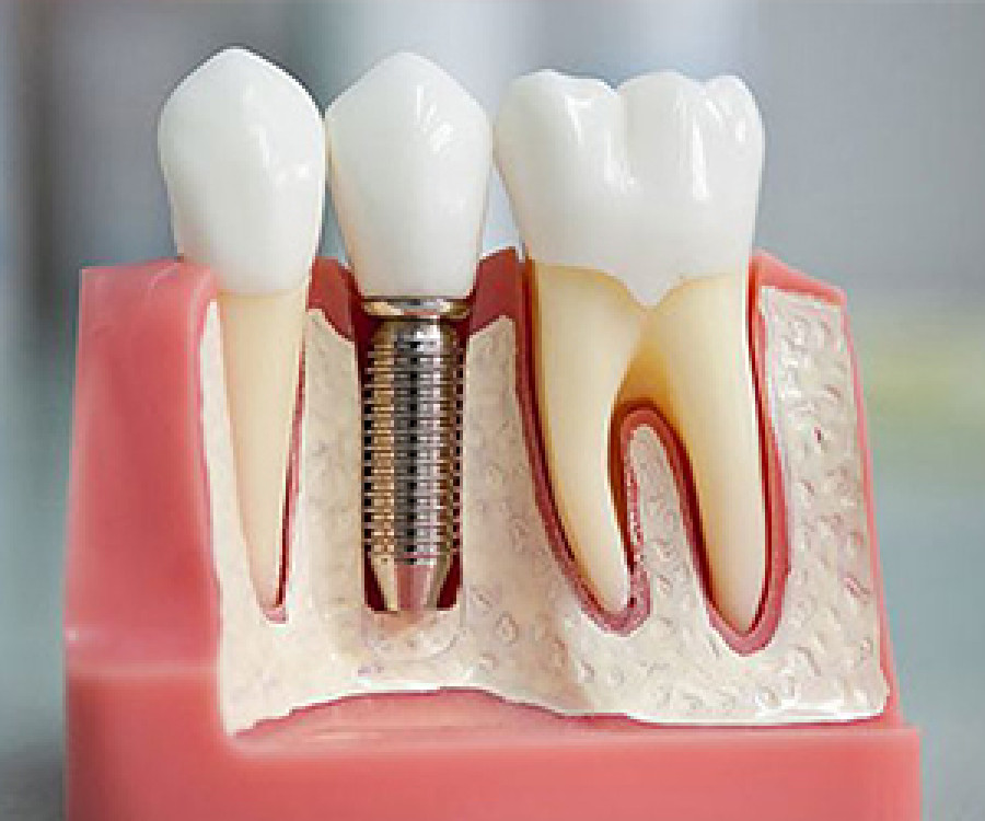 Bursa İmplant Fiyatları 2025 - Çene Cerrahi Bursa