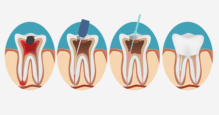 Bursa DM Diş Klinik - Kanal Tedavisi Nedir?