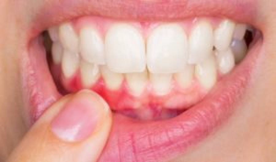 Diş Eti Çekilmesi Nedir?