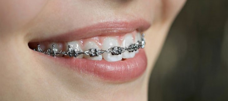 Ortodonti Tedavisi Bilmeniz Gerekenler Dr.Dt. Canan Çolak