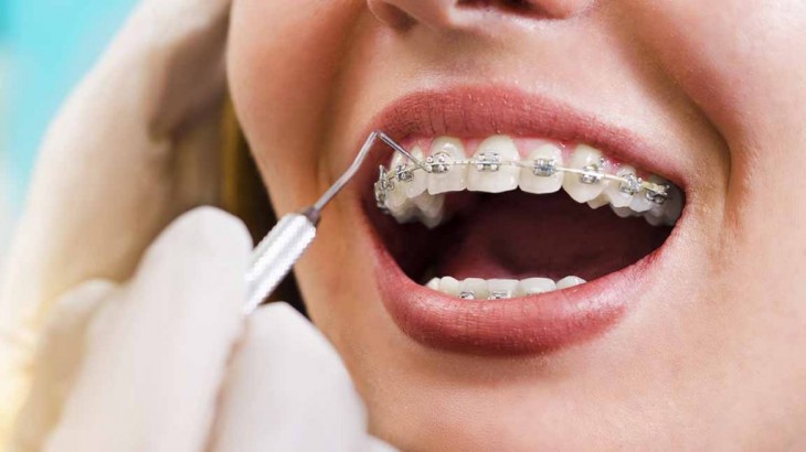 Bursa’nın En İyi Ortodonti Uygulama Merkezi