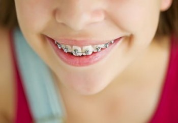 Diş Çapraşıklığı Nedir?