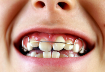 Bursa Ortodontist Önerileri