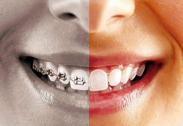 Bursa diş teli Tedavisi - DM ağız ve diş sağlığı