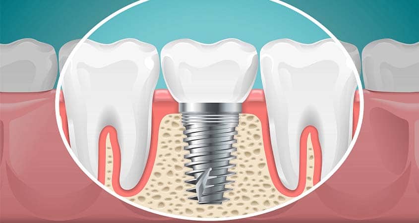 bursa implant merkezi - dm dis