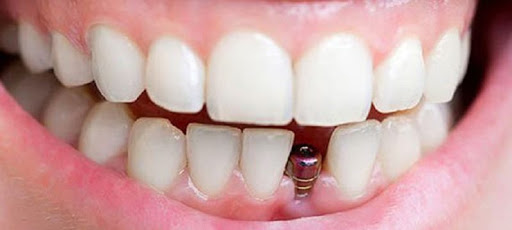 Dm dis tek dis implant